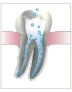 Płyny do płukania kanałów – materiały endodontyczne